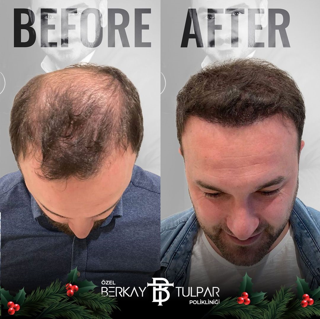 Hair Transplant – Private Berkay Tulpar Policlinic